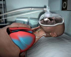 Non-invasive ventilation