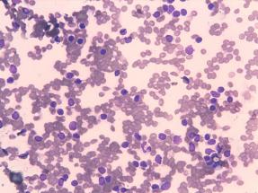 punció transbronquial aspirativa amb presència abundant de limfòcits